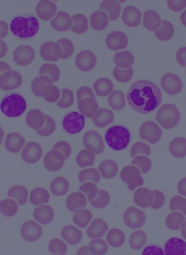 Chronic Lymphocytic Leukemia