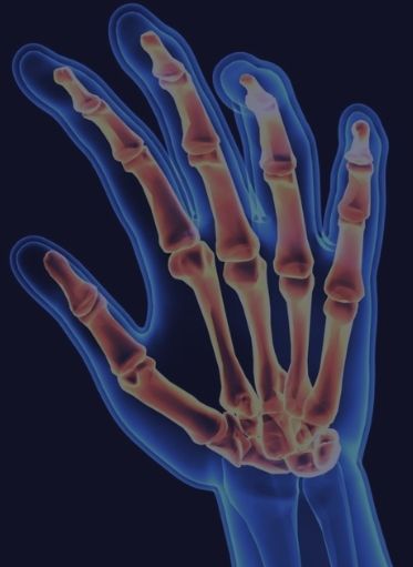 Rheumatoid Arthritis